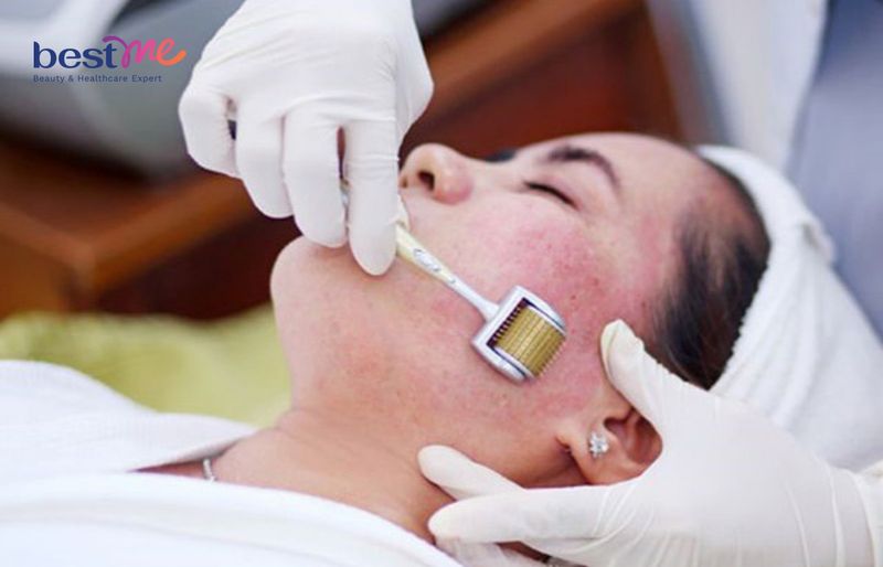 Dùng Công nghệ lăn kim và peel da phục hồi