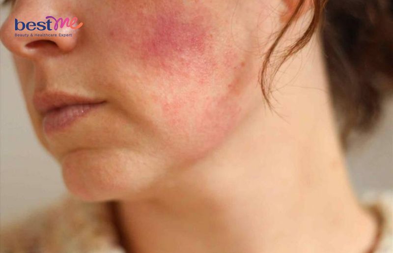 Cấp độ 1 khi da nhiễm corticoid