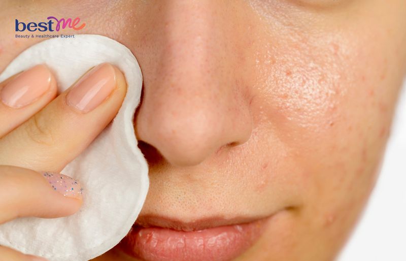 Việc làm sạch da là một bước quan trọng trong việc chăm sóc da nhiễm corticoid