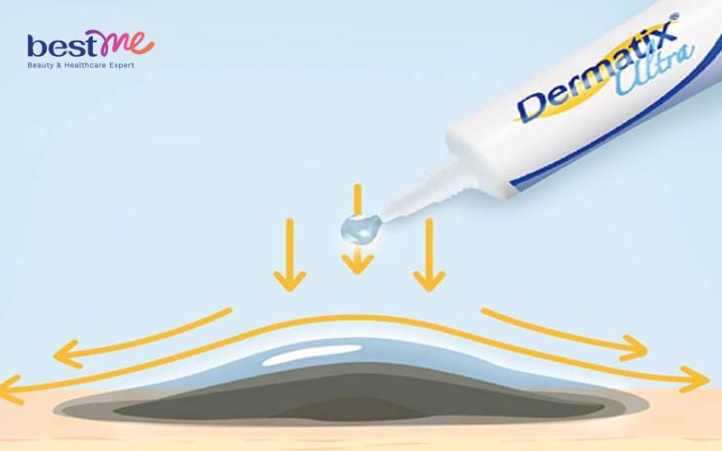 dermatix-ultra-co-tri-tham-mun-khong-chuyen-gia-giai-dap-2 Dermatix Ultra có trị thâm mụn không? Chuyên gia giải đáp - 2