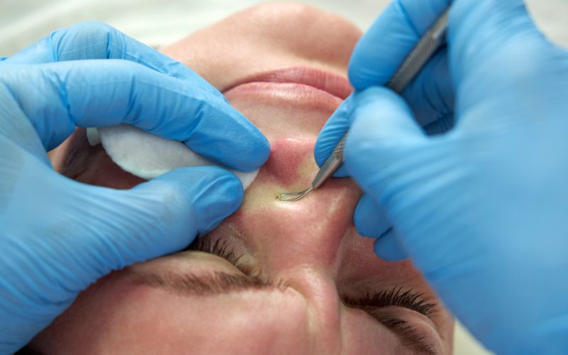 di-spa-nan-mun-tat-tan-tat-thong-tin-ban-can-phai-biet-1 Đi Spa nặn mụn: Tất tần tật thông tin bạn cần phải biết - 1