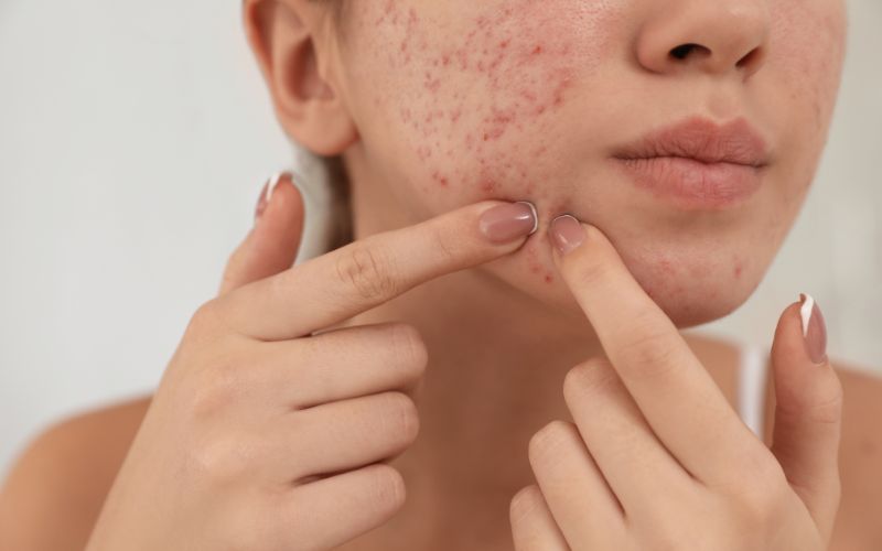 di-spa-nan-mun-tat-tan-tat-thong-tin-ban-can-phai-biet-8 Đi Spa nặn mụn: Tất tần tật thông tin bạn cần phải biết - 8