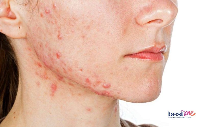 Một trong những dấu hiệu là dị ứng da mặt nổi mụn nước