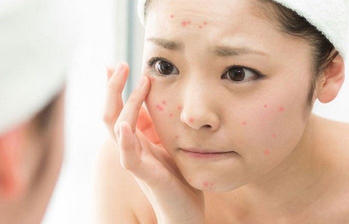 Da nổi mẩn đỏ vì dị ứng kem chống nắng