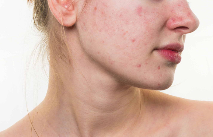 Dị ứng mỹ phẩm mức độ nhẹ