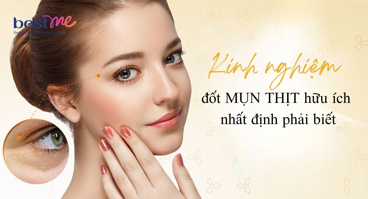 Hình ảnh và kinh nghiệm đi đốt mụn thịt nhất định cần biết