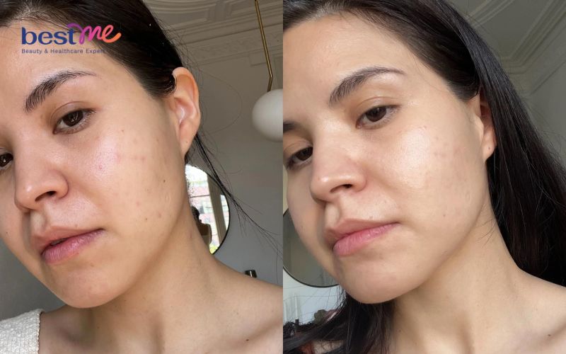 Hiểu đúng về quá trình đẩy mụn