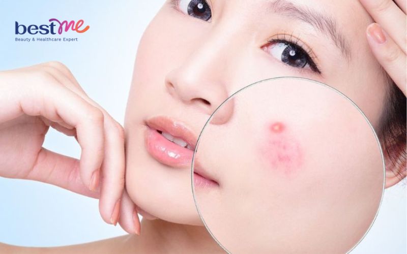 giai-dap-mun-boc-co-tu-xep-khong-khong-nan-co-tu-het-khong-2 Giải đáp: Mụn bọc có tự xẹp không? Không nặn có tự hết không? - 2
