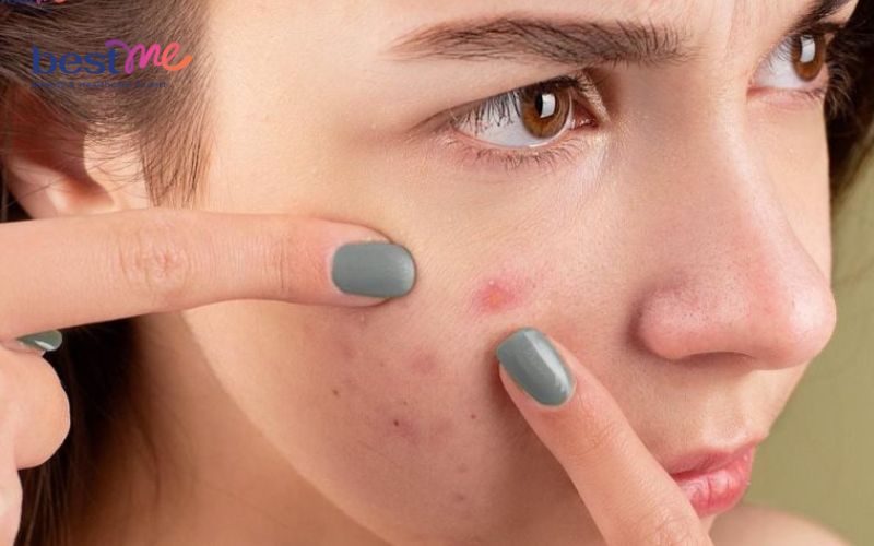 giai-dap-mun-boc-co-tu-xep-khong-khong-nan-co-tu-het-khong-3 Giải đáp: Mụn bọc có tự xẹp không? Không nặn có tự hết không? - 3