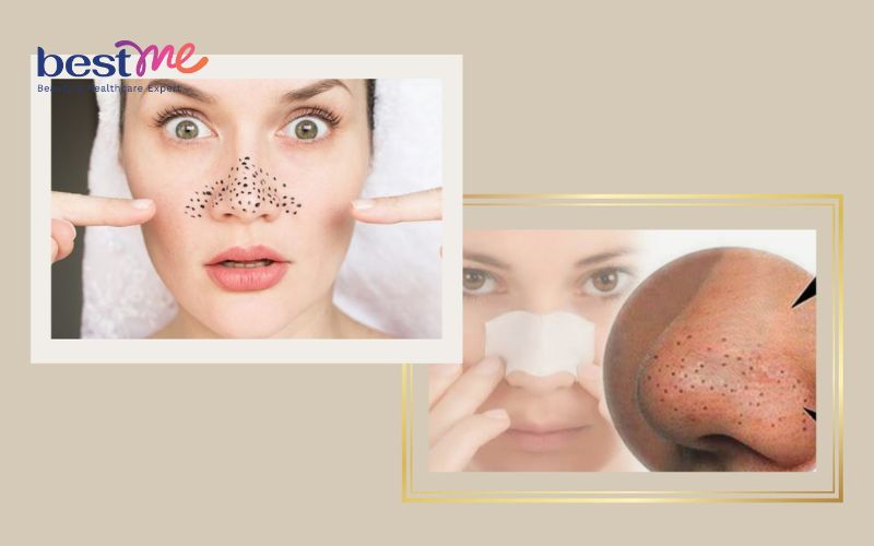 giai-ma-cach-tri-mun-dau-den-o-mui-bang-vaseline-co-tot-khong-4 Giải mã cách trị mụn đầu đen ở mũi bằng Vaseline có tốt không? - 4