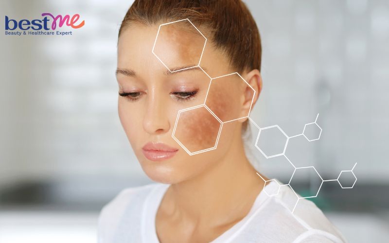 Giải mã Tranexamic Acid trị nám có hiệu quả và an toàn không? - 1