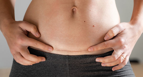 Bao lâu thì có thể thấy hiệu quả khi áp dụng cách giảm mỡ bụng sau khi sinh mổ? 
