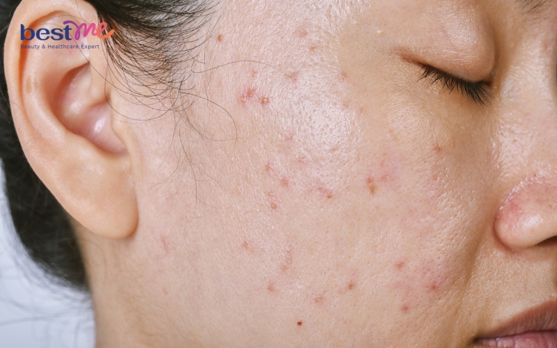 goi-y-routine-cham-soc-da-hon-hop-thien-dau-moi-ngay-2 Gợi ý routine chăm sóc da hỗn hợp thiên dầu mỗi ngày - 2