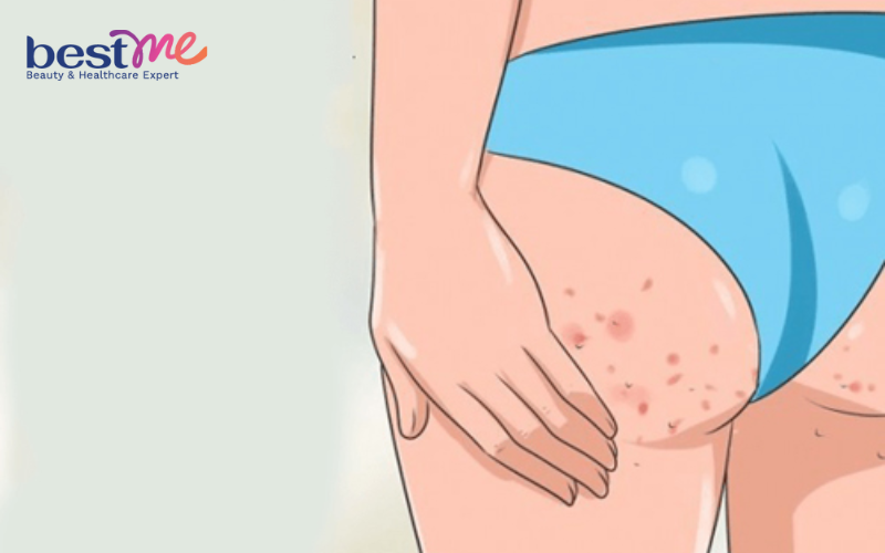 he-lo-4-cach-tri-mun-nhot-bi-chai-cung-o-mong-nhanh-nhat-1 Hé lộ 4 cách trị mụn nhọt bị chai cứng ở mông nhanh nhất - 1