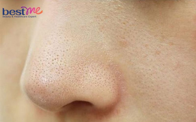 Hé lộ cách trị mụn ẩn ở mũi hiệu quả triệt để không tái phát - 1