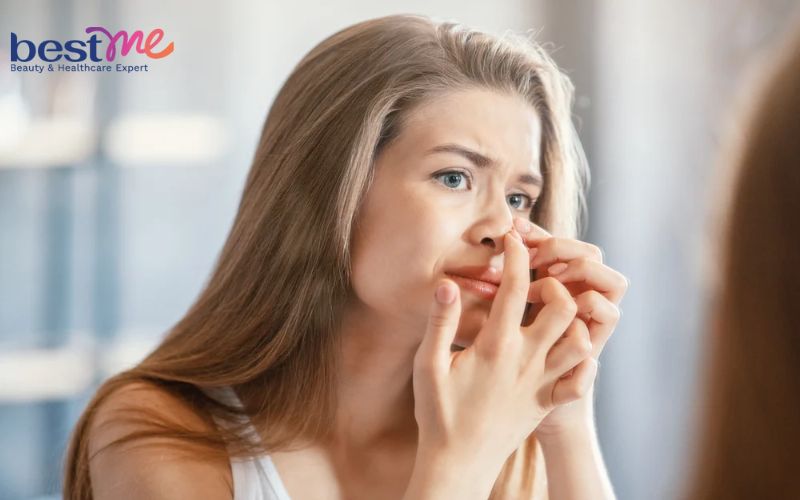 Hé lộ cách trị mụn ẩn ở mũi hiệu quả triệt để không tái phát - 2