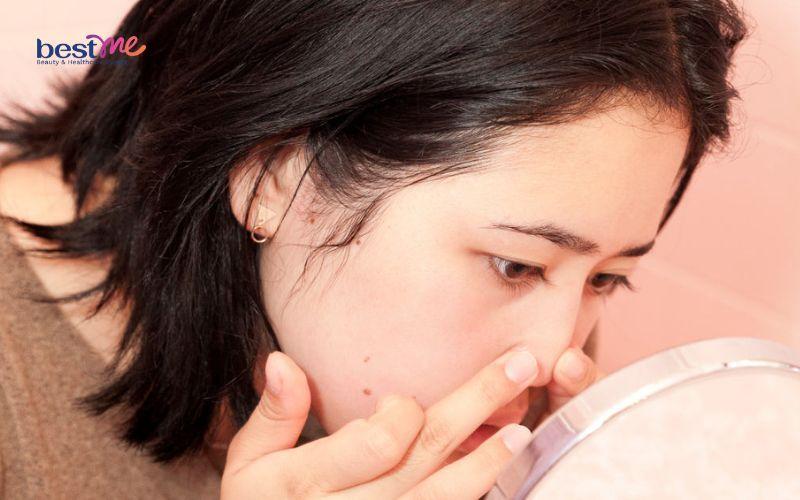 he-lo-cach-tri-mun-mu-o-mui-don-gian-hieu-qua-nhanh-nhat-4 Hé lộ cách trị mụn mủ ở mũi đơn giản hiệu quả nhanh nhất - 4