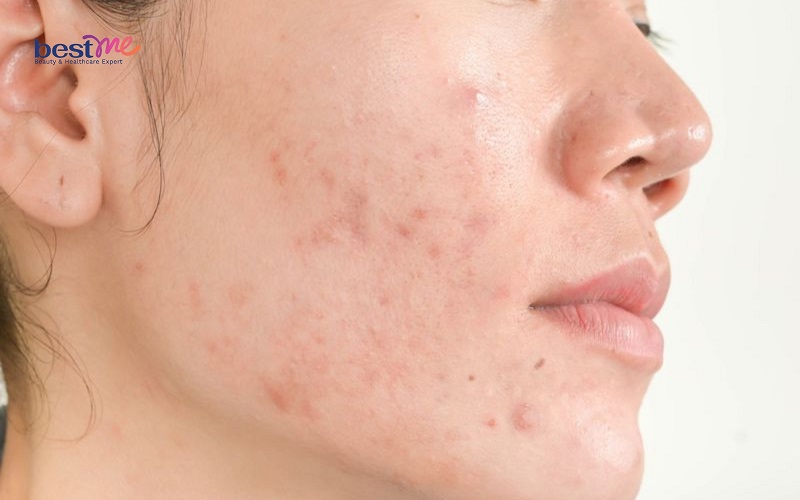 he-lo-cach-xu-ly-dieu-tri-mun-viem-khong-nhan-hieu-qua-nhat-1 Hé lộ cách xử lý, điều trị mụn viêm không nhân hiệu quả nhất - 1