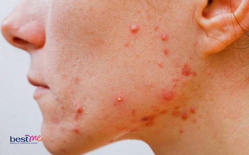 he-lo-cach-xu-ly-dieu-tri-mun-viem-khong-nhan-hieu-qua-nhat-3 Hé lộ cách xử lý, điều trị mụn viêm không nhân hiệu quả nhất - 3