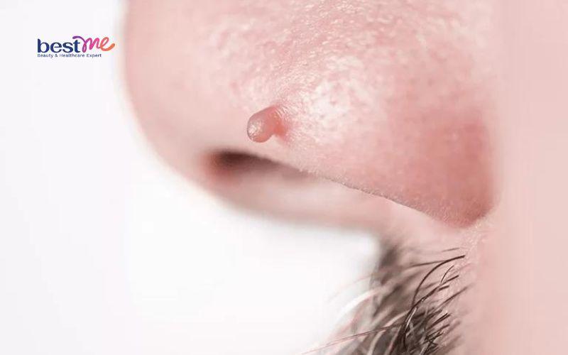 Hé lộ những cách trị mụn thịt ở mũi hiệu quả triệt để nhất - 2