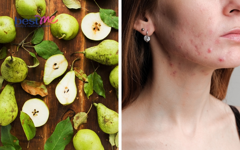 he-lo-su-that-an-le-co-noi-mun-khong-co-tot-cho-da-mun-2 Hé lộ sự thật Ăn lê có nổi mụn không? Có tốt cho da mụn? - 2