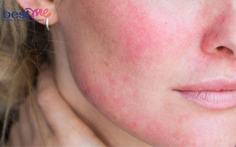 Bệnh nấm da mặt : Nguyên nhân, hình ảnh, điều trị hiệu quả