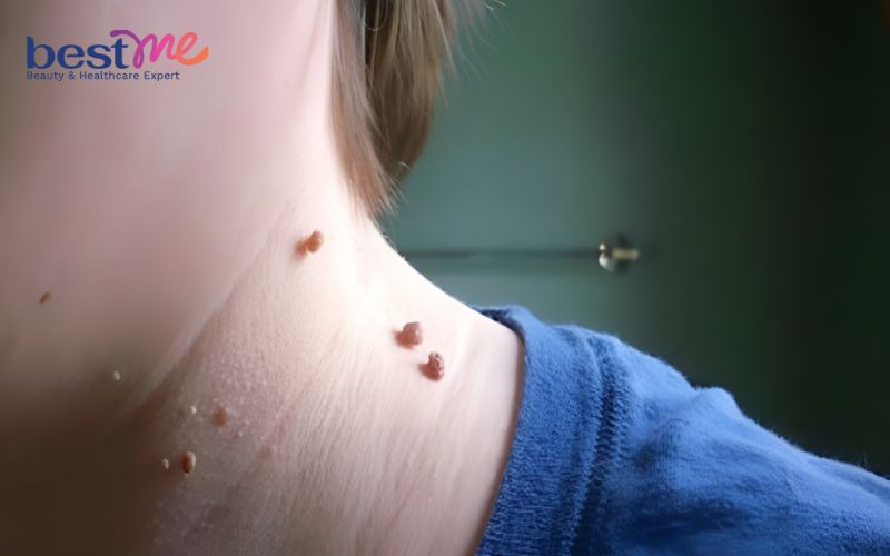 hinh-anh-mun-coc-o-co-va-cach-chua-tri-hieu-qua-triet-de-1 Hình ảnh mụn cóc ở cổ và cách chữa trị hiệu quả triệt để - 1