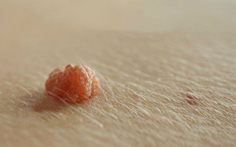 hinh-anh-mun-coc-o-co-va-cach-chua-tri-hieu-qua-triet-de-4 Hình ảnh mụn cóc ở cổ và cách chữa trị hiệu quả triệt để - 4