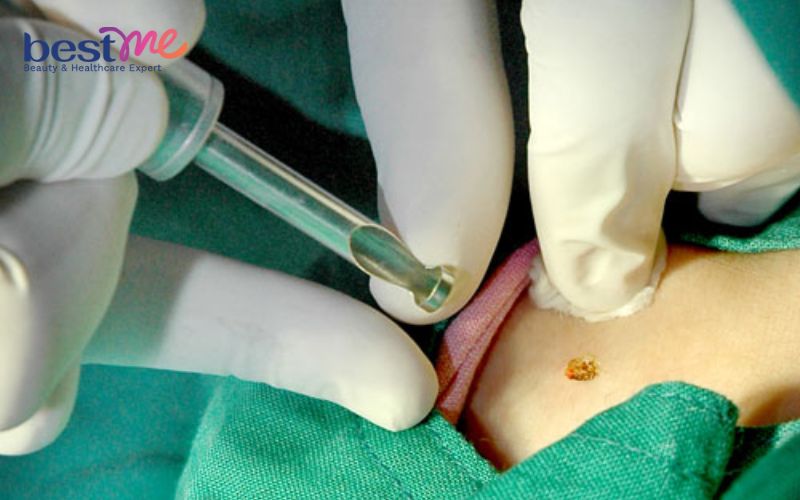 hinh-anh-mun-coc-o-co-va-cach-chua-tri-hieu-qua-triet-de-7 Hình ảnh mụn cóc ở cổ và cách chữa trị hiệu quả triệt để - 7