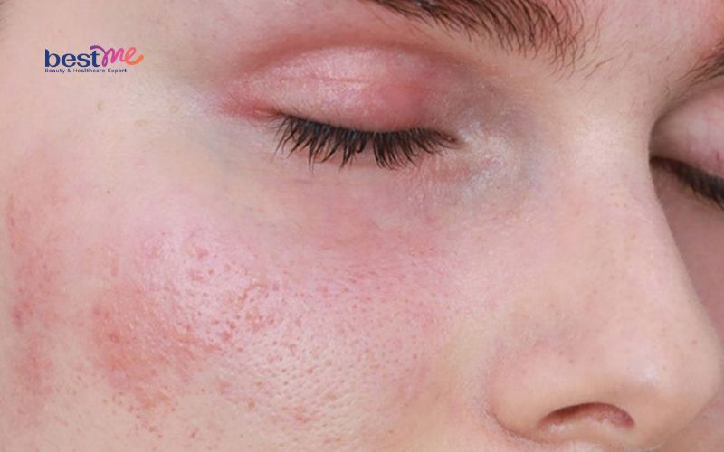Viêm da tiếp xúc dị ứng ở mặt: Hình ảnh, cách chữa trị tốt nhất