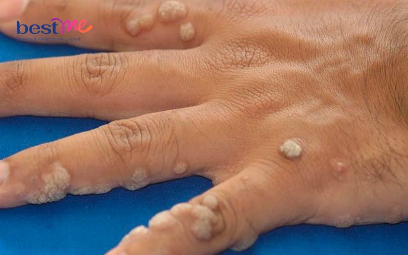 huong-dan-cach-tri-noi-mun-coc-o-ngon-tay-hieu-qua-nhat-1 Hướng dẫn cách trị nổi mụn cóc ở ngón tay hiệu quả nhất - 1