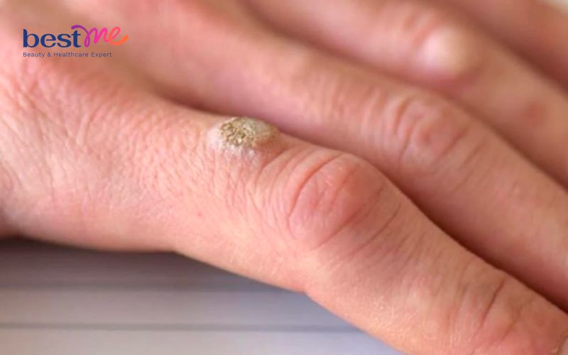 huong-dan-cach-tri-noi-mun-coc-o-ngon-tay-hieu-qua-nhat-2 Hướng dẫn cách trị nổi mụn cóc ở ngón tay hiệu quả nhất - 2