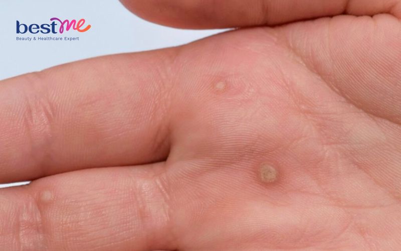 huong-dan-cach-tri-noi-mun-coc-o-ngon-tay-hieu-qua-nhat-3 Hướng dẫn cách trị nổi mụn cóc ở ngón tay hiệu quả nhất - 3