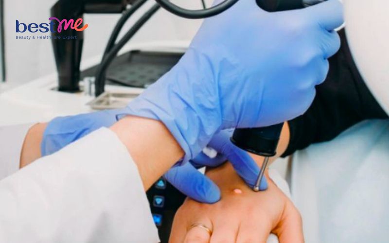 huong-dan-cach-tri-noi-mun-coc-o-ngon-tay-hieu-qua-nhat-7 Hướng dẫn cách trị nổi mụn cóc ở ngón tay hiệu quả nhất - 7