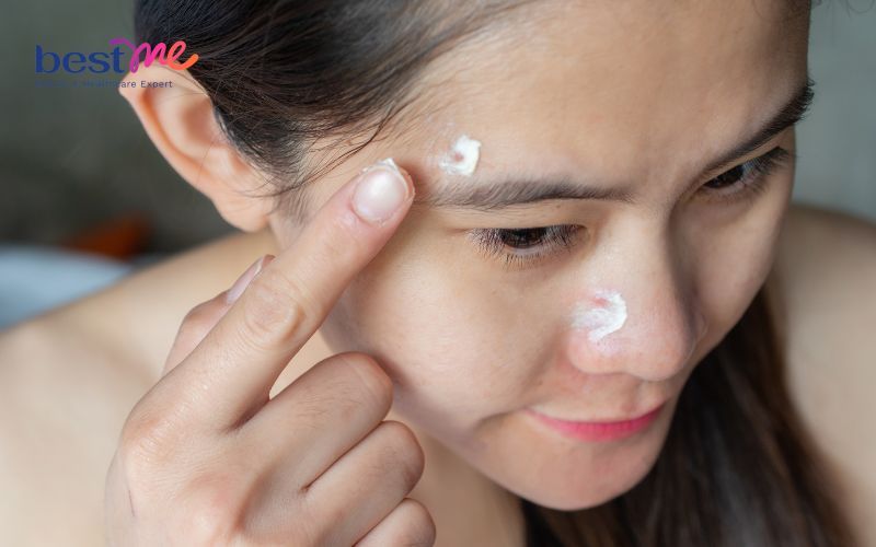 huong-dan-nhung-cach-day-mun-an-ra-ngoai-hieu-qua-nhat-7 Hướng dẫn những cách đẩy mụn ẩn ra ngoài hiệu quả nhất - 7