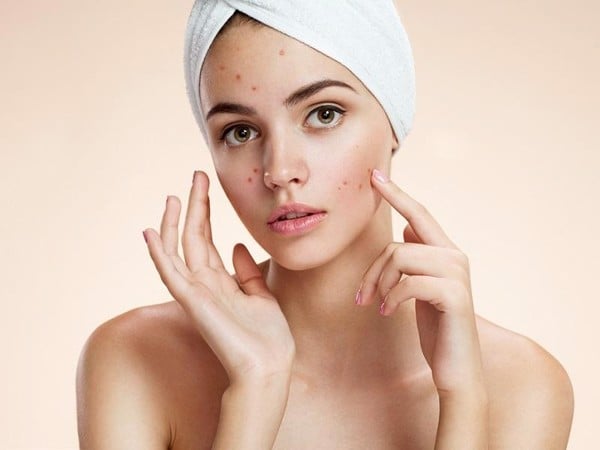 Giải đáp các thắc mắc thường gặp về viên uống trị mụn nội tiết - 1