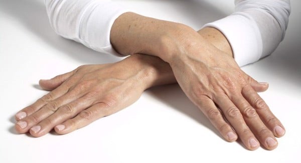 Những gân xanh, đỏ nổi lên vì da mỏng