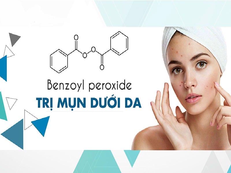 Gọi tên các thành phần nên có trong sản phẩm trị mụn