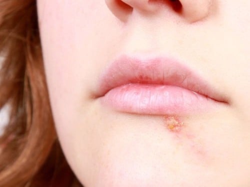 điều trị da dầu mụn