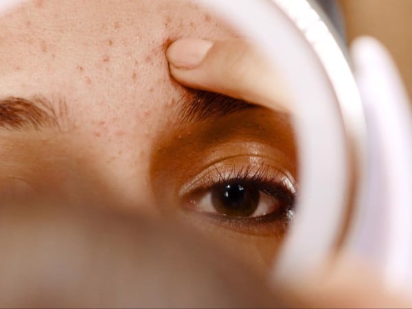 Muốn chăm sóc da bị mụn cần rửa mặt bao nhiêu lần/ngày? - 5