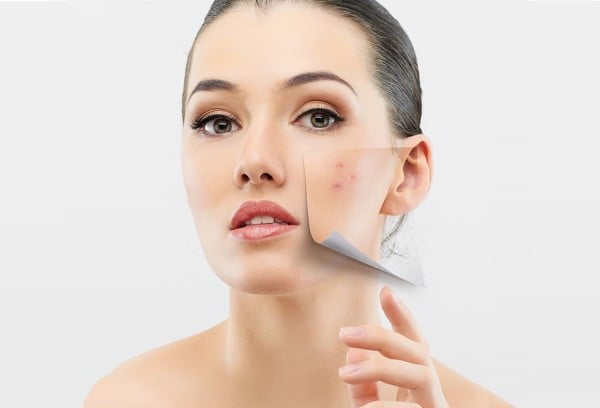  Da mụn phù hợp với loại kem dưỡng ẩm da mặt nào? 