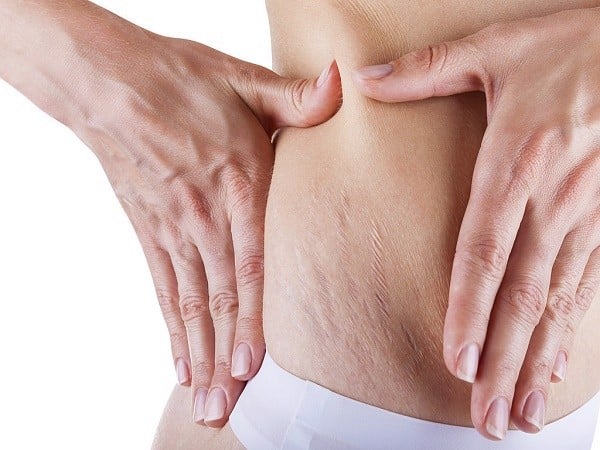Tác dụng của dầu oliu trong trị rạn da không phải ai cũng biết - 1