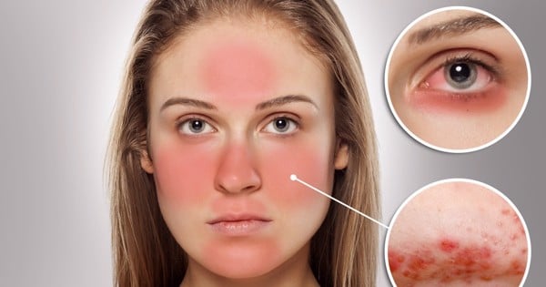 Chăm sóc da nhạy cảm bị mụn với sữa rửa mặt trà xanh - 1