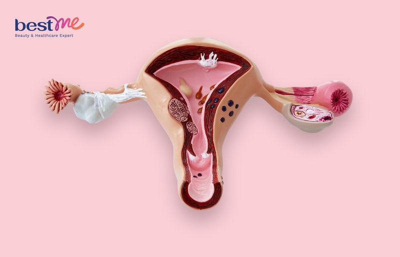 Inositol cải thiện các triệu chứng của hội chứng buồng trứng đa nang