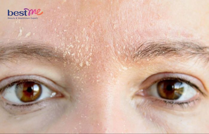 Làn da khô thường có đặc điểm bề mặt thô ráp