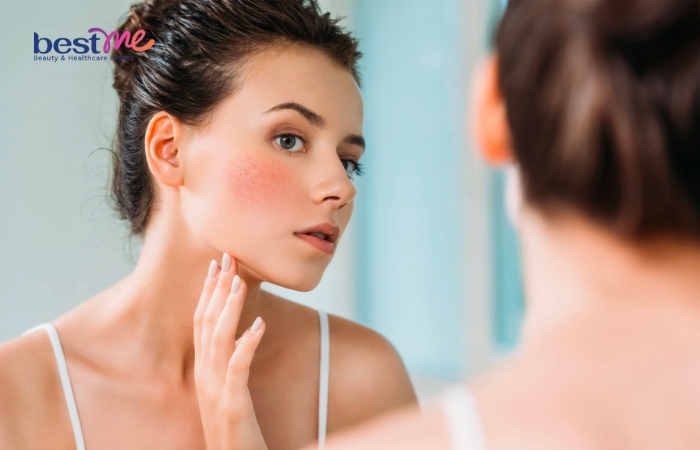 Da nhạy cảm vẫn cần sử dụng kem chống nắng để bảo vệ da