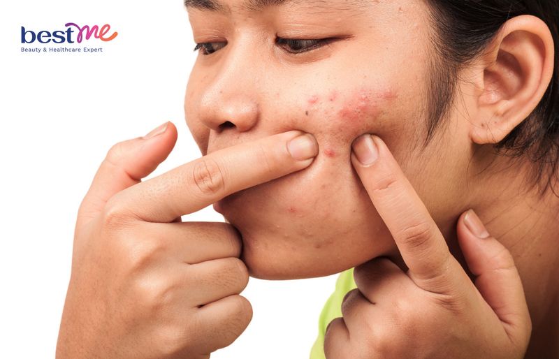 Mụn trên da dầu còn được gây ra từ nhiều nguyên nhân khác nhau