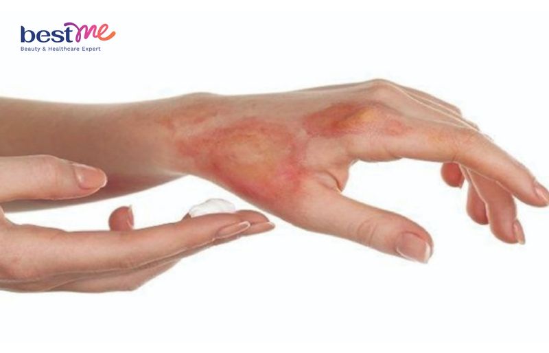 Nhiều trường hợp bỏng da khi sử dụng kem tan mỡ bụng