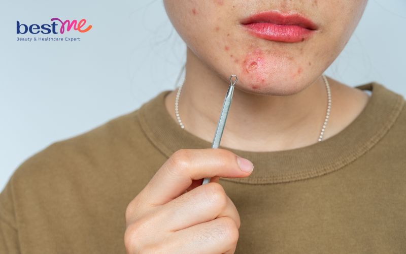 Khám phá cách trị mụn nội tiết ở cằm hiệu quả triệt để nhất - 1