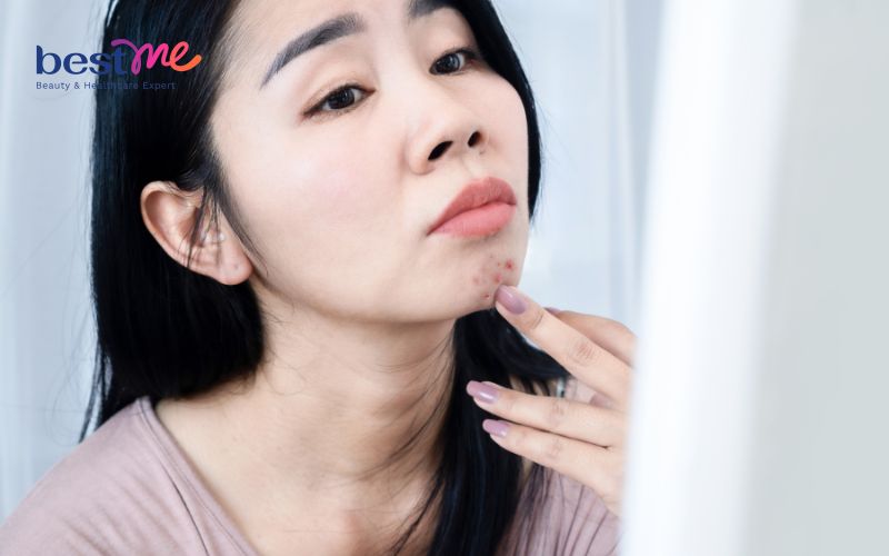 Khám phá cách trị mụn nội tiết ở cằm hiệu quả triệt để nhất - 7
